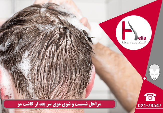 Steps of washing hair after hair transplantation