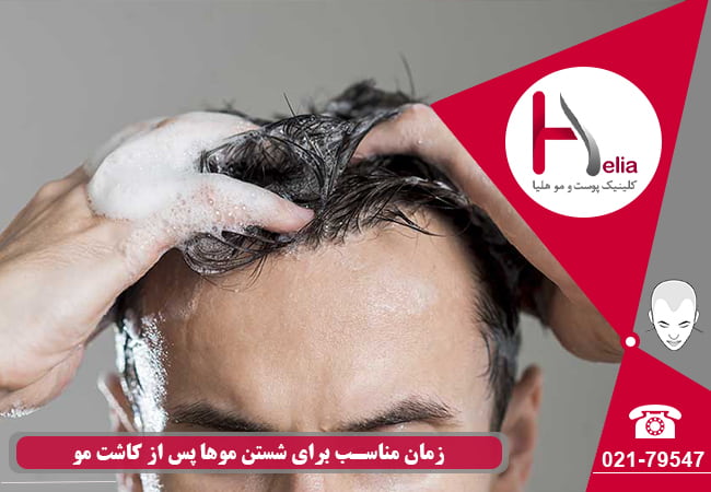The right time to wash your hair after hair transplant