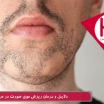 دلایل و درمان ریزش موی صورت در مردان