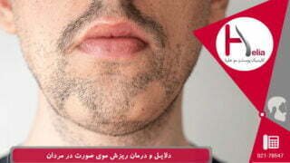 دلایل و درمان ریزش موی صورت در مردان