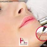 الکترولیز موهای زائد