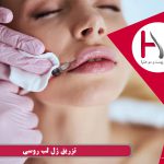 تزریق ژل لب روسی