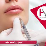تزریق ژل لب سه دکمه