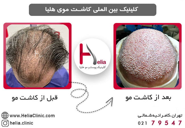عکس قبل و بعد پرتراکم ترین روش کاشت مو در ایران