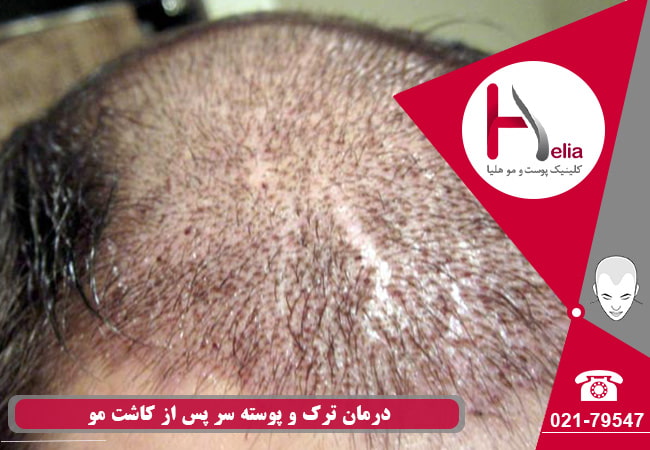 درمان ترک و پوسته شدن سر بعد از پیوند مو