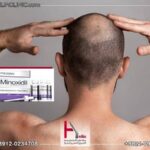 همه چیز درباره ماینوکسیدیل و مزایا آن