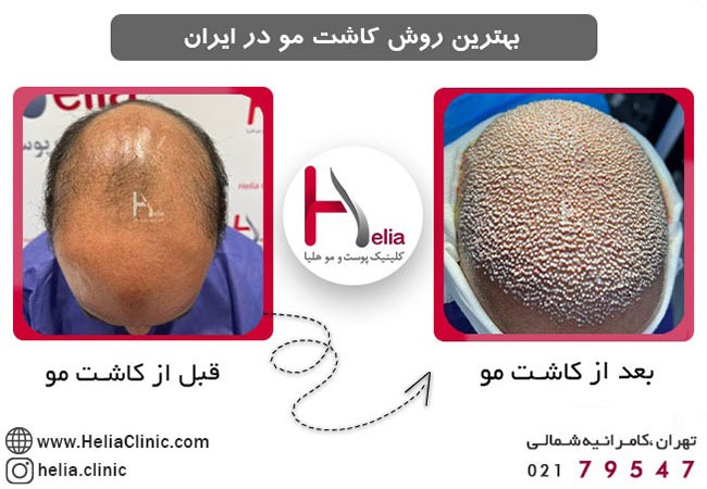 بهترین روش کاشت مو در ایران در کلینیک بین المللی هلیا