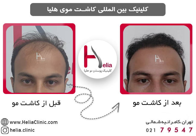 قبل و بعد از کاشت مو