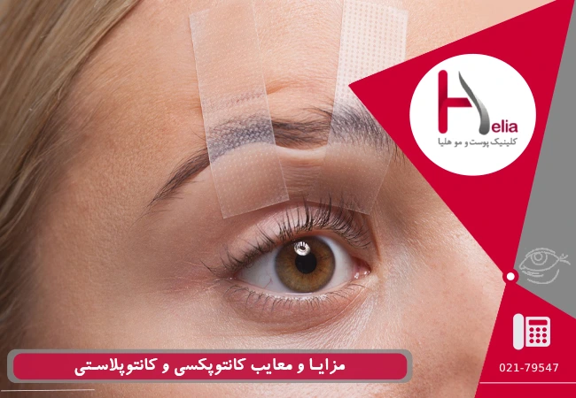 مزایا و معایب کانتوپکسی و کانتوپلاستی