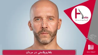 بلفاروپلاستی در آقایان