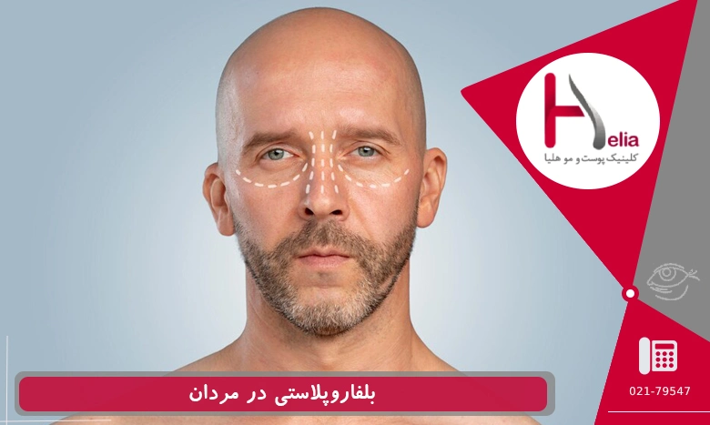 بلفاروپلاستی در آقایان