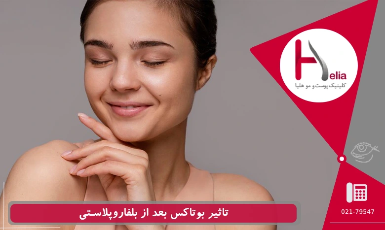 بوتاکس بعد از بلفاروپلاستی