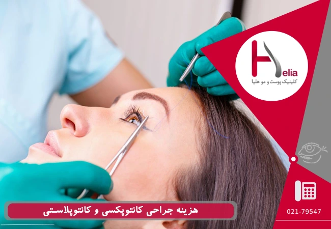 هزینه جراحی کانتوپکسی و کانتوپلاستی