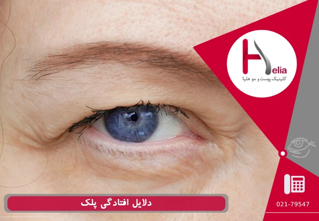 دلایل افتادگی پلک