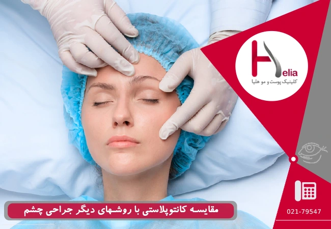 مقایسه کانتوپلاستی با روش‌های دیگر جراحی چشم