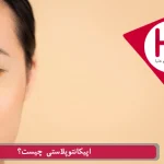 اپیکانتوپلاستی