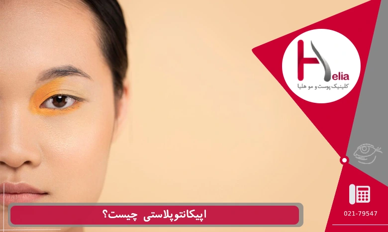 اپیکانتوپلاستی