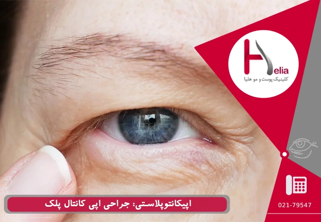 اپیکانتوپلاستی