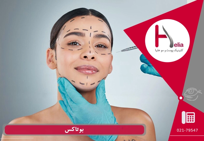 لیفت چشم با بوتاکس