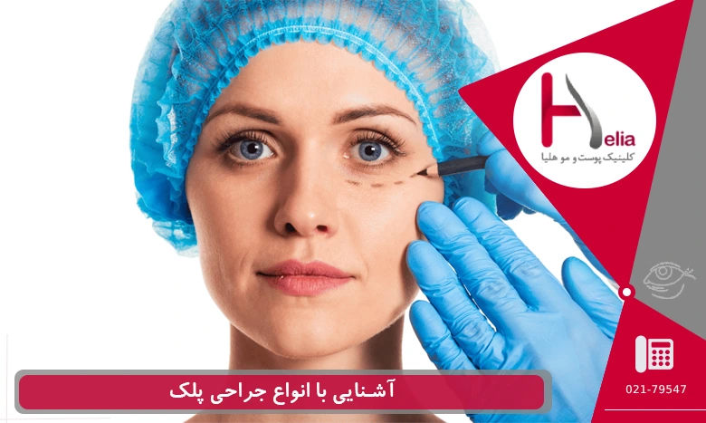جدیدترین روش های جراحی پلک در ایران