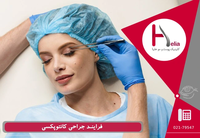 جراحی کانتوپکسی چگونه انجام می شود؟