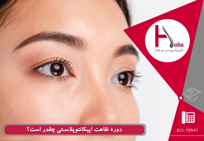 دوره نقاهت اپیکانتوپلاستی چقدر است؟