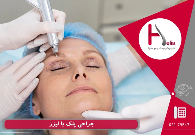جراحی پلک با لیزر