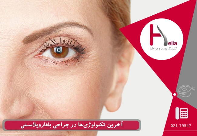 آخرین تکنولوژی‌ها در جراحی بلفاروپلاستی