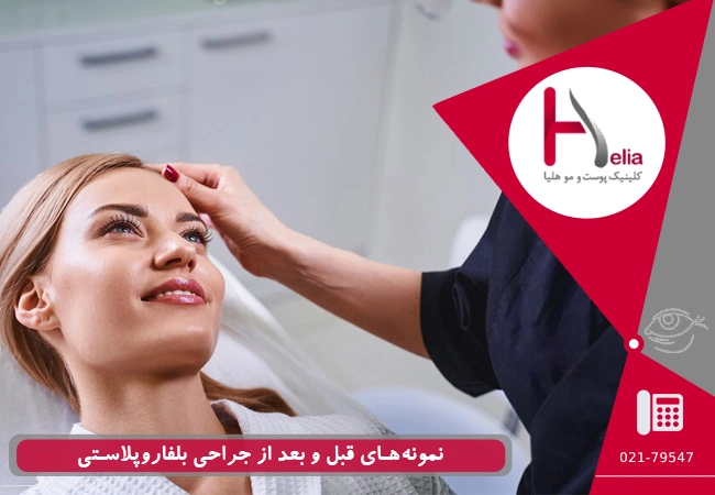 نمونه‌های قبل و بعد از جراحی بلفاروپلاستی