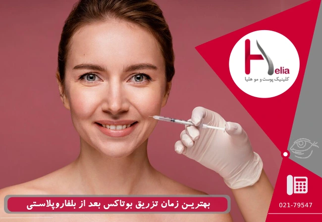 بهترین زمان تزریق بوتاکس بعد از بلفاروپلاستی
