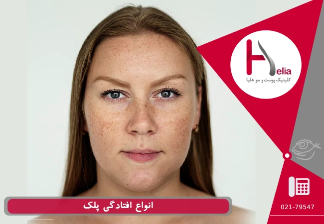 انواع افتادگی پلک