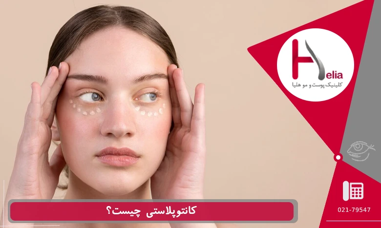 کانتوپلاستی چیست؟