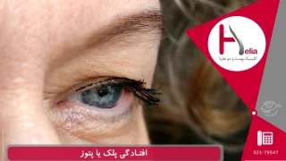 افتادگی پلک چشم