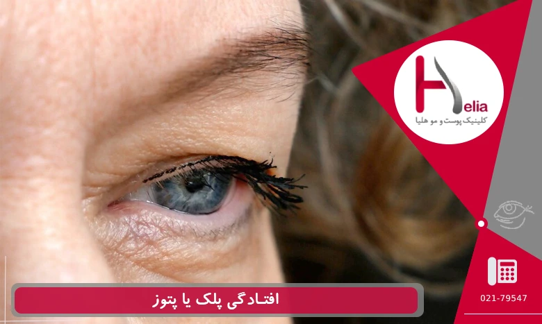 افتادگی پلک چشم