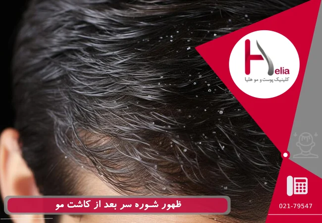 ظهور شوره سر بعد از کاشت مو