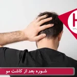 شوره زدن بعد از کاشت مو