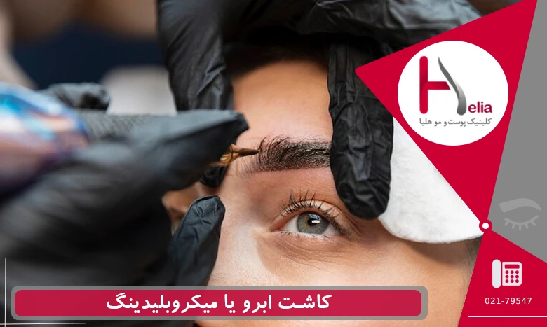 کاشت ابرو یا میکروبلیدینگ