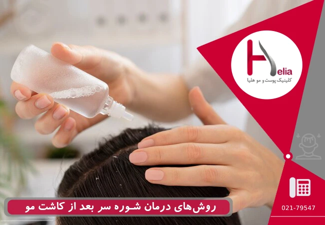 درمان شوره سر بعد از کاشت مو