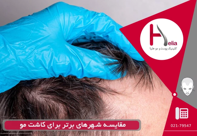 مقایسه شهرهای برتر برای کاشت مو