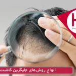 بهترین روش های جایگزین کاشت مو