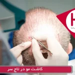 کاشت مو در تاج سر