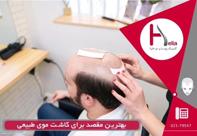 بهترین مقصد برای کاشت موی طبیعی
